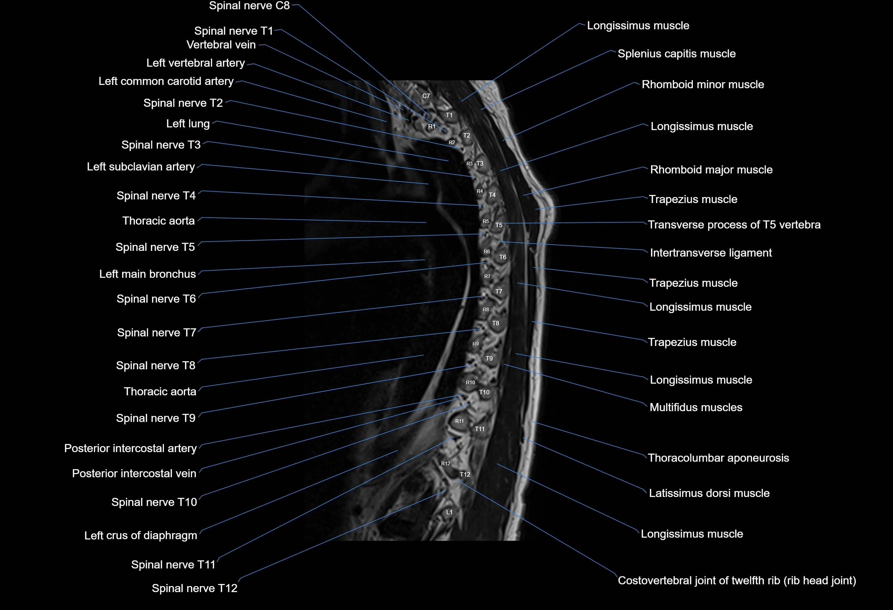 MRI thoracic spine sagittal  cross sectional anatomy 3T radiology  image-img-00001-00022.webp